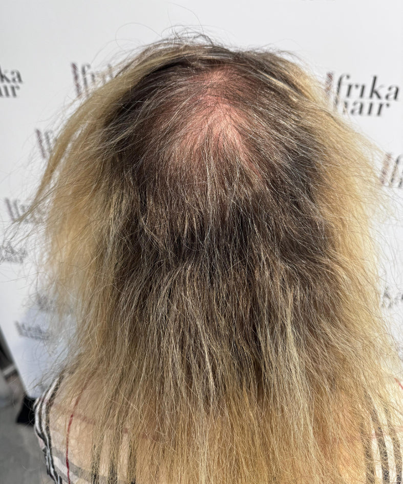Hair Loss from Chemotherapy: What to Expect and How to Prepare